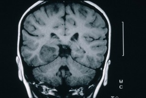 view MRI scan; brain cancer (astrocytoma)