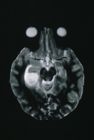 view MRI scan; brain cancer (astrocytoma)