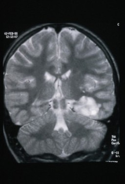 MRI scan; brain cancer (primitive neuroectodermal)