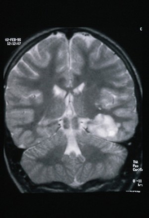 view MRI scan; brain cancer (primitive neuroectodermal)