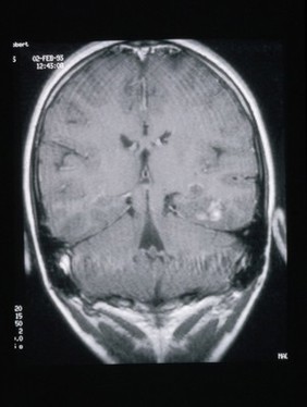 MRI scan; brain cancer (primitive neuroectodermal)