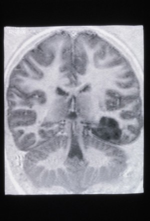 view MRI scan; brain cancer (primitive neuroectodermal)