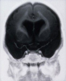 Pachygyria, bilateral fronto- parietal