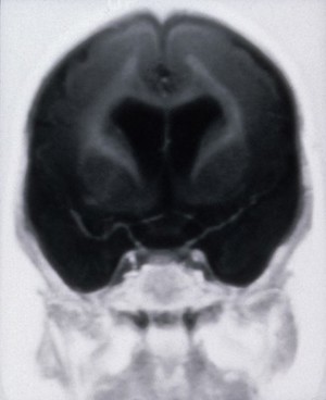 view Pachygyria, bilateral fronto- parietal