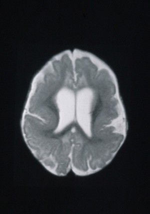 view Pachygyria, bilateral fronto-parietal