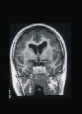 Pachygyria, bifrontal