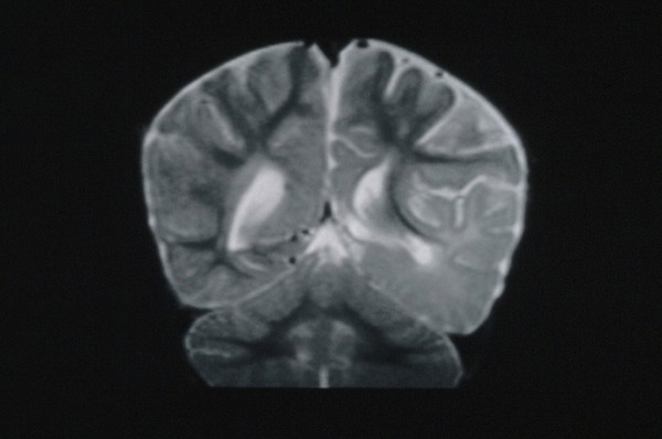 Pachygyria. Linear sebaceous naevus