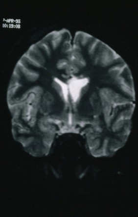 Medial Temporal Sclerosis. Left