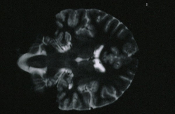 Medial Temporal Sclerosis. Left