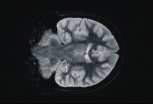 view Medial Temporal Sclerosis