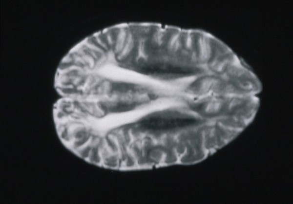 Periventricular Leucomalacia