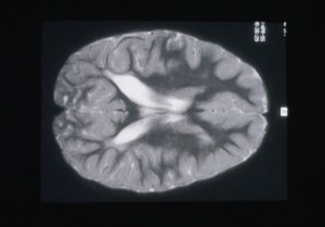 view Leucomalacia, periventricular