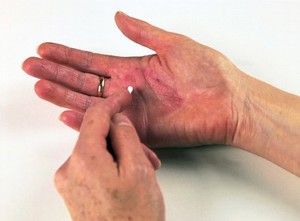 view Applying hydrocortisone cream to eczema