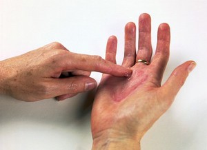 view Applying steroid ointment to eczema - hand