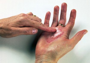 view Applying steroid ointment to eczema - hand