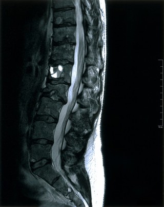 MRI scan; spine metastases from breast cancer