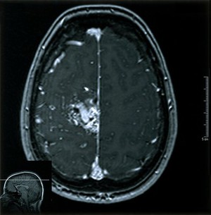 view Cerebral arterio-venous malfunction. 12.06.2002