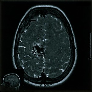 view Cerebral arterio-venous malfunction. 2.06.2002