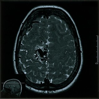 Cerebral arterio-venous malfunction. 2.06.2002