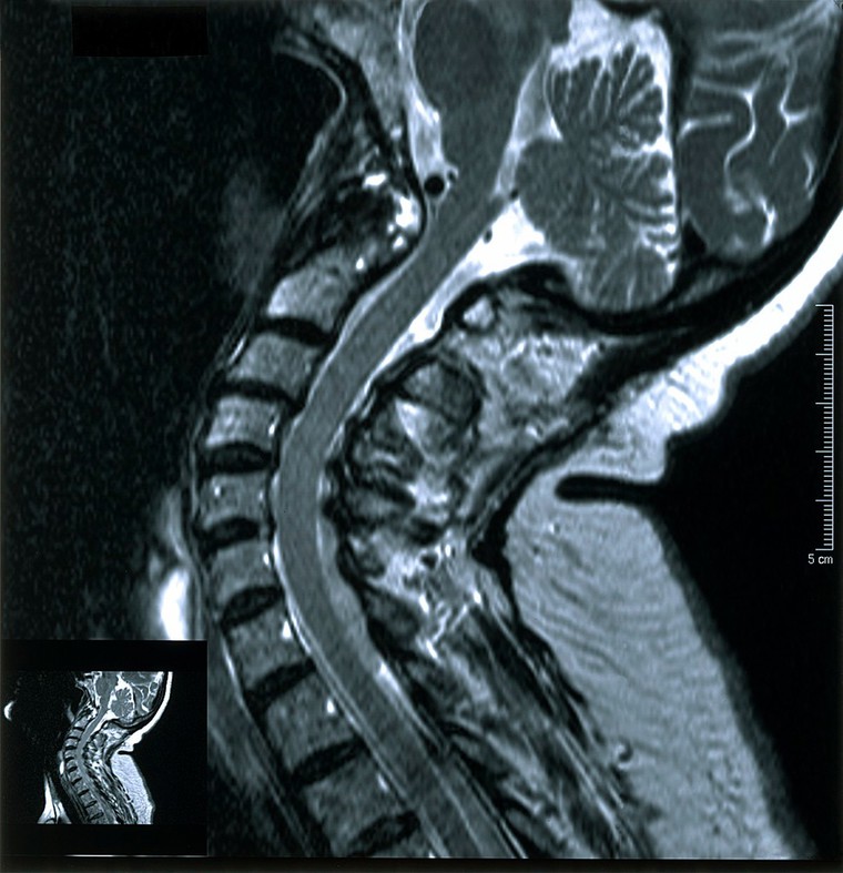 Rheumatoid Arthritis Of Cervical Spine 2002 Wellcome Collection 0695