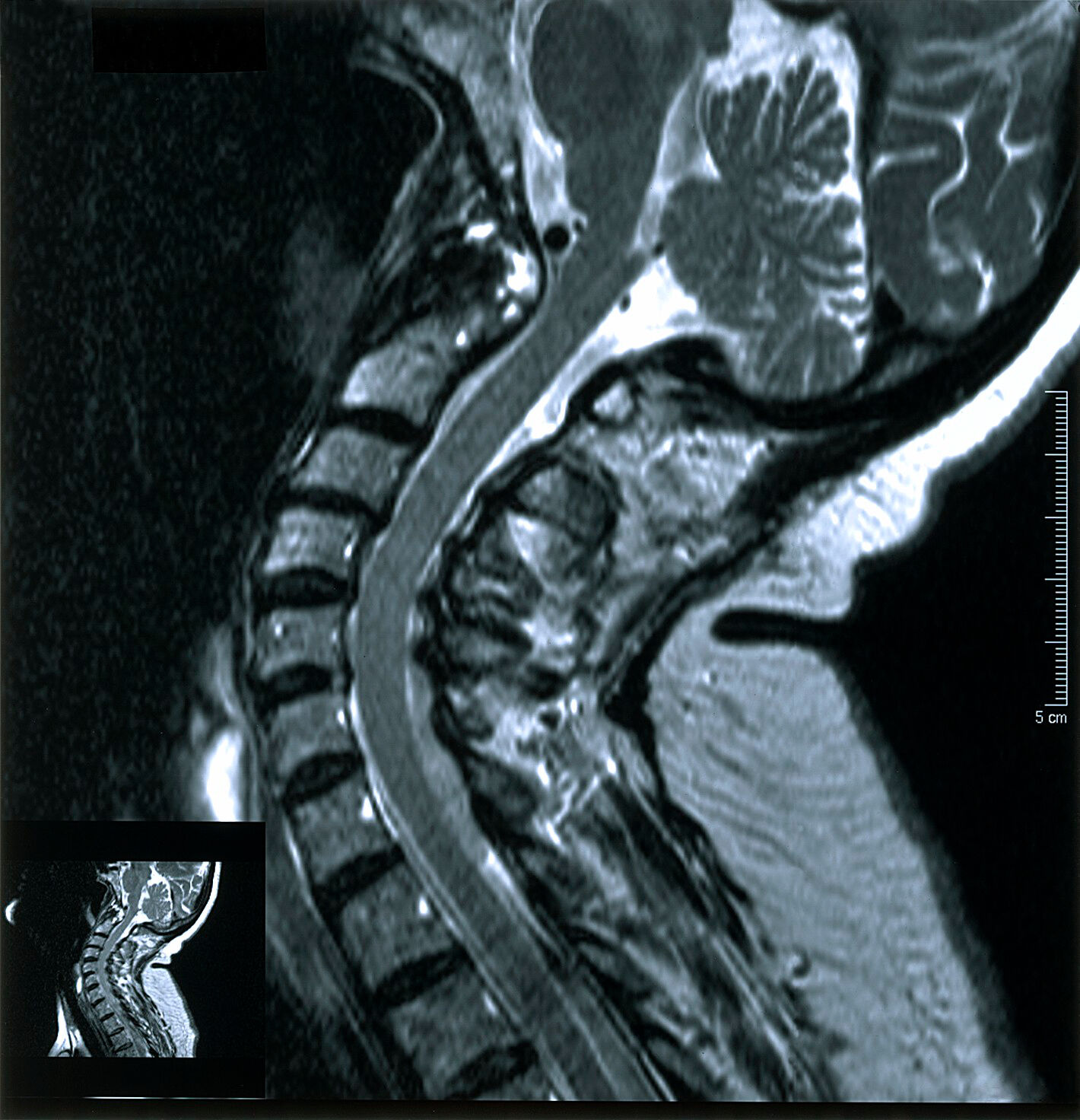 Rheumatoid arthritis of cervical spine. 2002 Collection