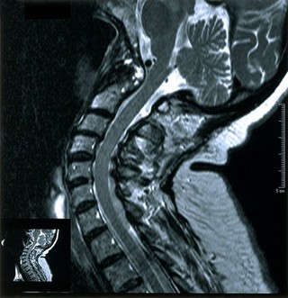 Rheumatoid arthritis of cervical spine. 2002