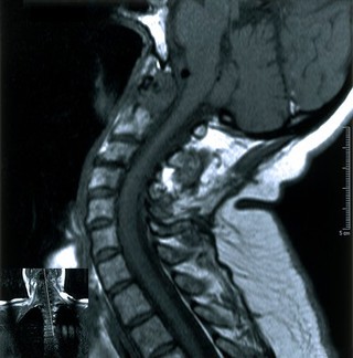 Rheumatoid arthritis of cervical spine. 2002