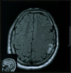 view Focal motor cortex cysticeriasis. 2002