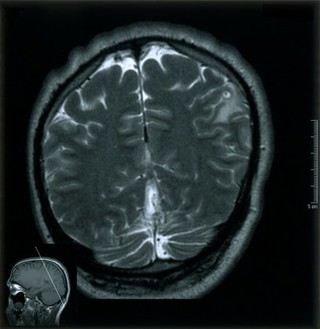 Focal motor cortex cysticeriasis. 2002