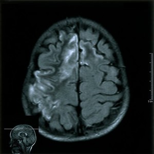 view Moya-moya disease. 2002