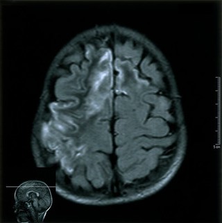 Moya-moya disease. 2002