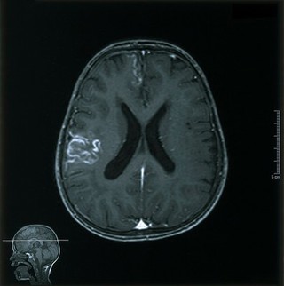 Moya-moya disease. 2002Magnetic resonance image