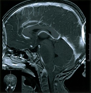 view MRI scan; brain cancer (glioma), brain stem