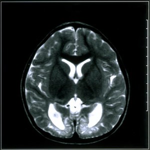 view Hypoglycaemia from birth injury.2002