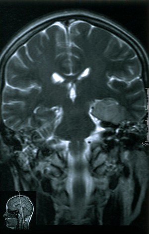 view Temporal lobe glioma. Low grade at 18.04.2001