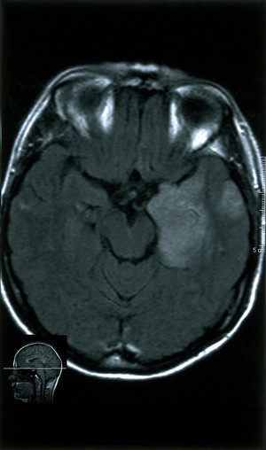 view Temporal lobe glioma.Low grade at 18.04.2001