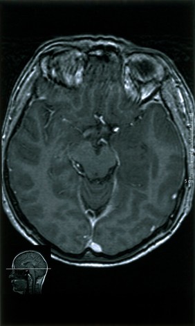 Temporal lobe glioma.Low grade at 18.04.2001