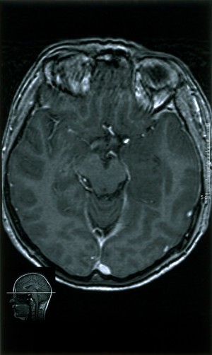 view Temporal lobe glioma.Low grade at 18.04.2001