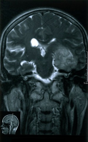 view Temporal lobe glioma.Active and malignant 18