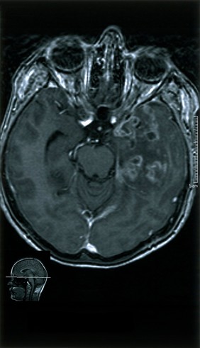 Temporal lobe glioma.Active and malignant 18