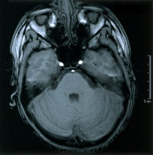 view Normal brain.1 Axial MRI scan