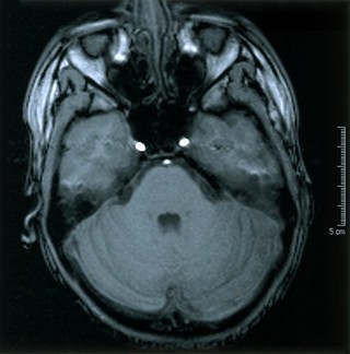 Normal brain.1 Axial MRI scan