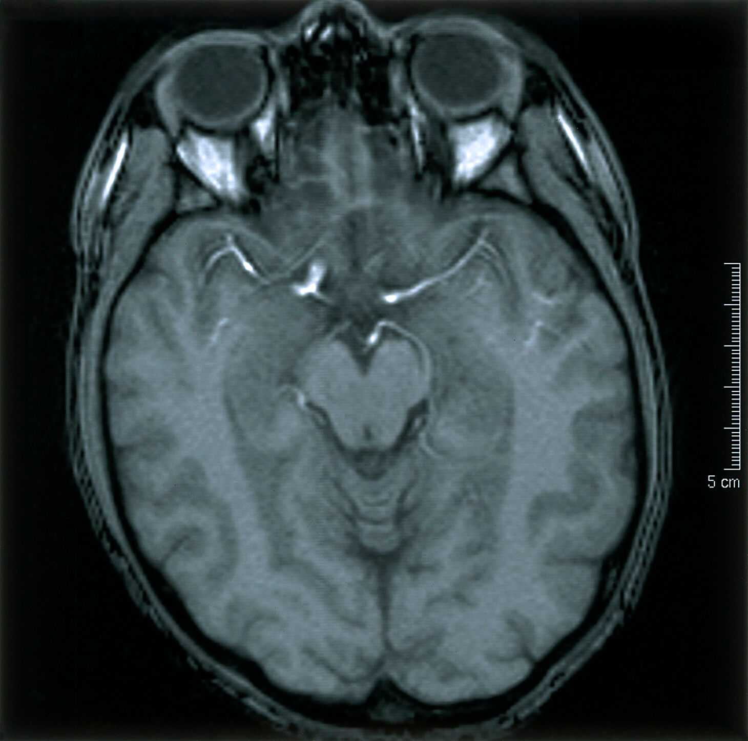 Normal Brain 2 Axial MRI Scan Wellcome Collection