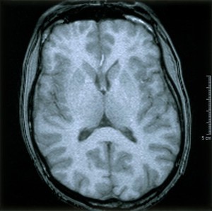 view Normal brain. 3 Axial MRI scan