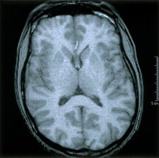 Normal brain. 3 Axial MRI scan