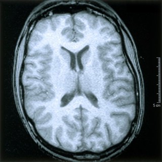 Normal brain. 4 Axial MRI scan