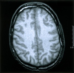 view Normal brain. 5 Axial MRI scan