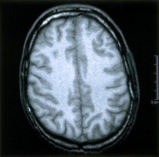 Normal brain. 5 Axial MRI scan