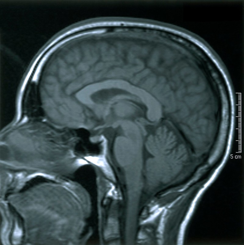 Normal brain. 6. Sagittal MRI scan | Wellcome Collection