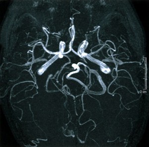 view Normal brain. 7. Angiogram - from top